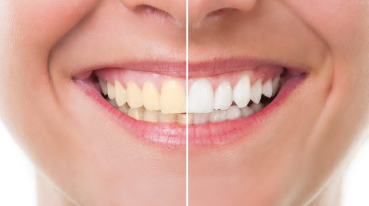 Before and after results of a Teeth Whitening Treatment.